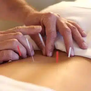 Acupuntura