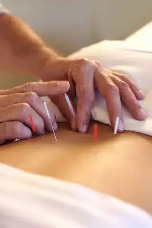 Acupuntura